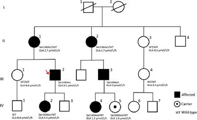 Case report: First diagnosis of Fabry disease in North Macedonia in a patient presenting with kidney failure on hemodialysis